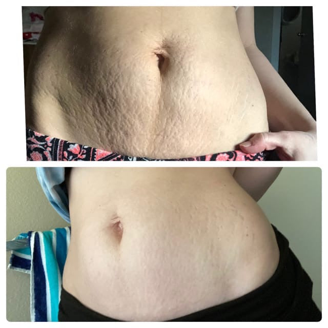 DRS 6 in 1  Derma Roller System