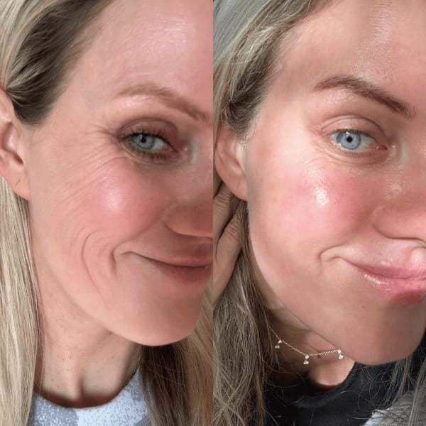 DRS 6 in 1  Derma Roller System