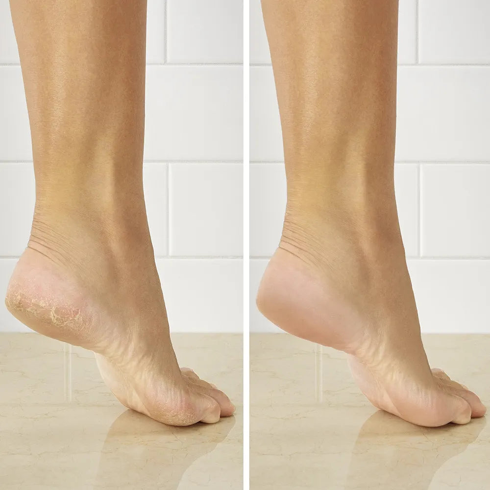 Callus Remover